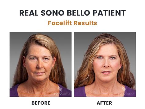 sono bello neck before and after pictures|sono bello facelift photos.